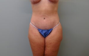 Before & After Pictures in Nashville, TN