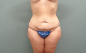Before & After Pictures in Nashville, TN