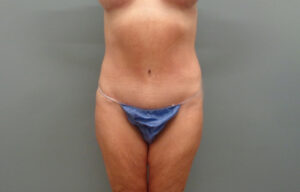 Before & After Pictures in Nashville, TN