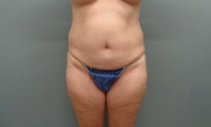 Before & After Pictures in Nashville, TN