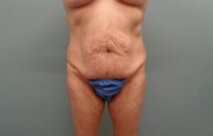 Before & After Pictures in Nashville, TN