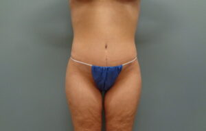 Before & After Pictures in Nashville, TN