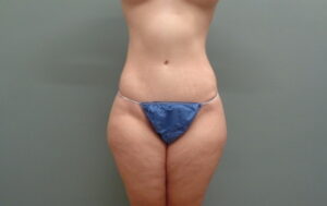 Before & After Pictures in Nashville, TN