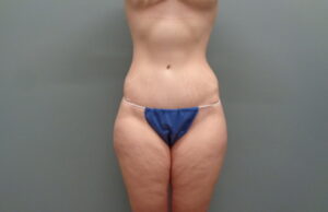 Before & After Pictures in Nashville, TN