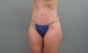 Before & After Pictures in Nashville, TN