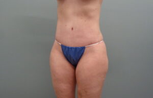 Before & After Pictures in Nashville, TN