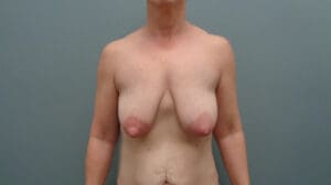 Before & After Pictures in Nashville, TN