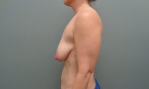 Before & After Pictures in Nashville, TN
