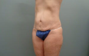 Before & After Pictures in Nashville, TN