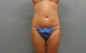 Before & After Pictures in Nashville, TN
