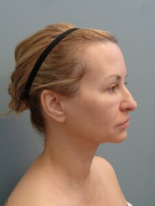 Before & After Pictures in Nashville, TN