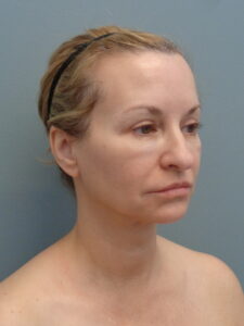 Before & After Pictures in Nashville, TN