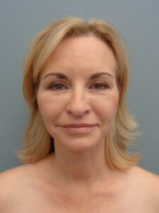 Before & After Pictures in Nashville, TN