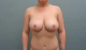 Before & After Pictures in Nashville, TN