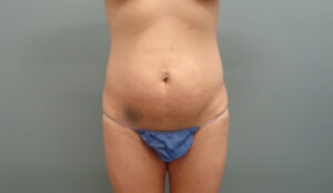 Before & After Pictures in Nashville, TN