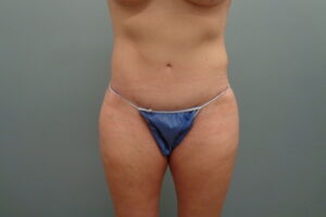 Before & After Pictures in Nashville, TN