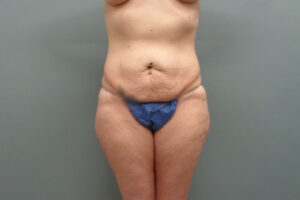 Before & After Pictures in Nashville, TN