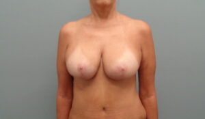 Before & After Pictures in Nashville, TN