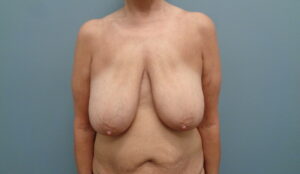 Before & After Pictures in Nashville, TN