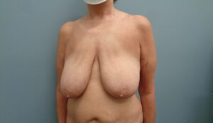 Before & After Pictures in Nashville, TN