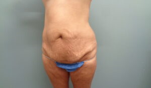 Before & After Pictures in Nashville, TN