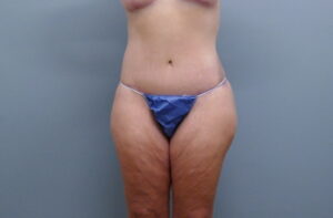 Before & After Pictures in Nashville, TN