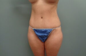 Before & After Pictures in Nashville, TN