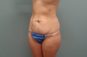 Before & After Pictures in Nashville, TN