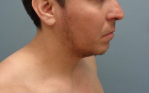 Before & After Pictures in Nashville, TN