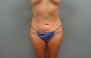 Before & After Pictures in Nashville, TN