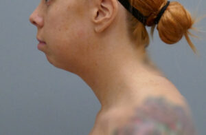 Before & After Pictures in Nashville, TN