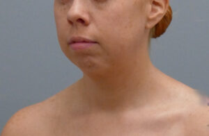 Before & After Pictures in Nashville, TN