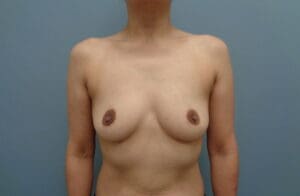 Before & After Pictures in Nashville, TN