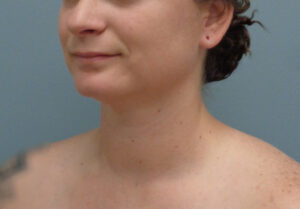 Before & After Pictures in Nashville, TN