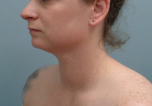 Before & After Pictures in Nashville, TN