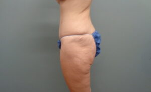 Before & After Pictures in Nashville, TN