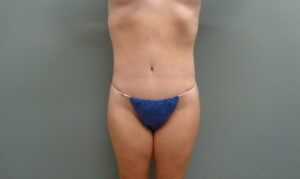 Before & After Pictures in Nashville, TN