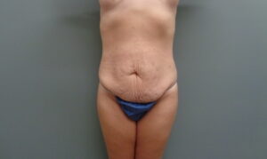 Before & After Pictures in Nashville, TN