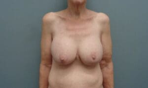 Before & After Pictures in Nashville, TN