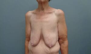 Before & After Pictures in Nashville, TN