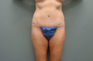 Before & After Pictures in Nashville, TN
