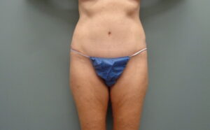 Before & After Pictures in Nashville, TN