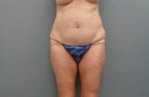 Before & After Pictures in Nashville, TN