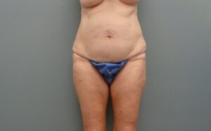 Before & After Pictures in Nashville, TN