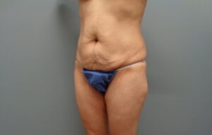 Before & After Pictures in Nashville, TN