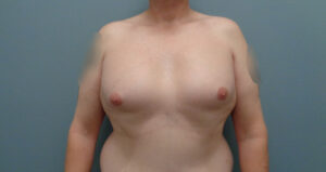 Before & After Pictures in Nashville, TN