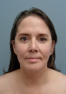 Before & After Pictures in Nashville, TN
