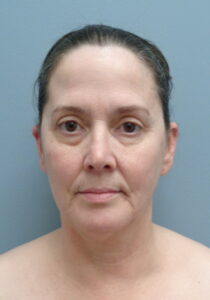 Before & After Pictures in Nashville, TN