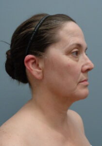 Before & After Pictures in Nashville, TN