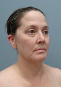 Before & After Pictures in Nashville, TN